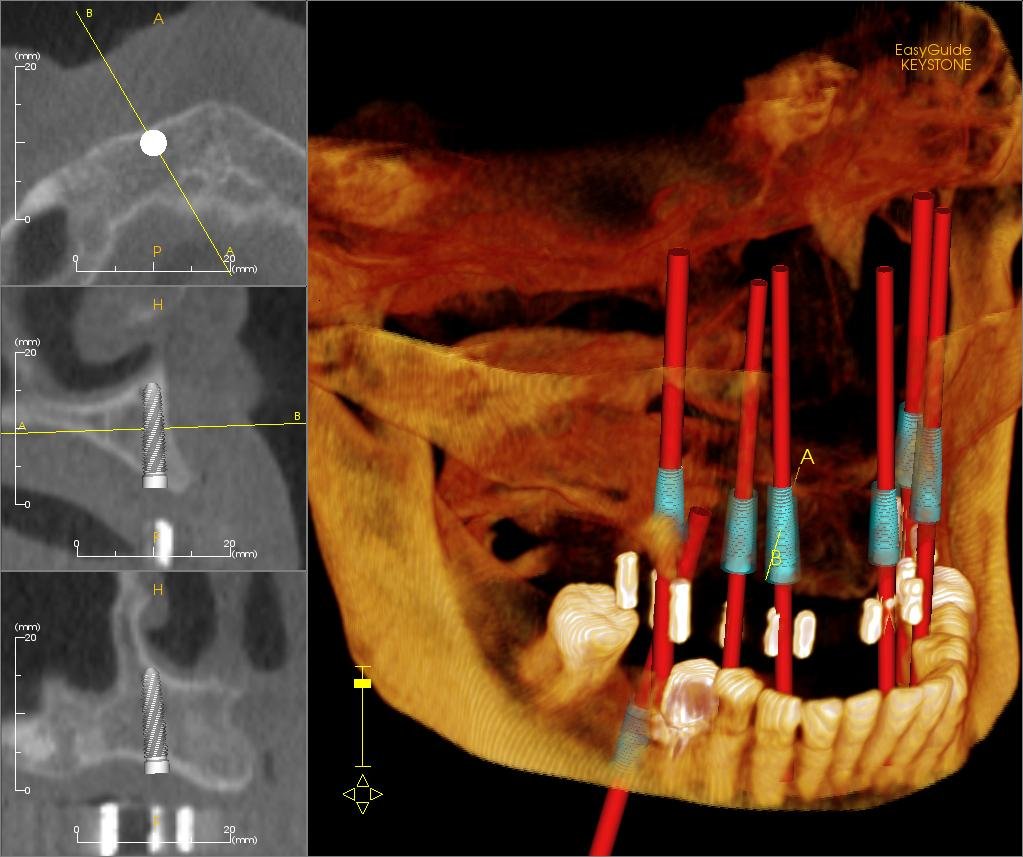 Dental Implants