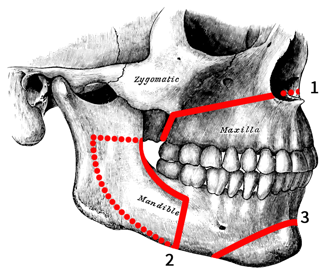 Facial Trauma & Jaw Surgery