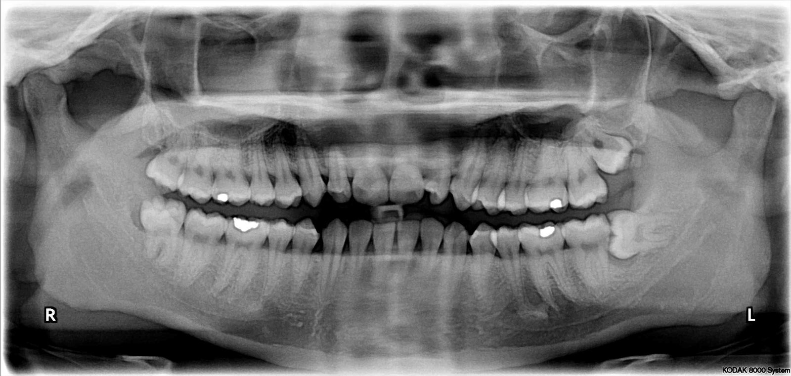 Impacted Wisdom Tooth Surgery